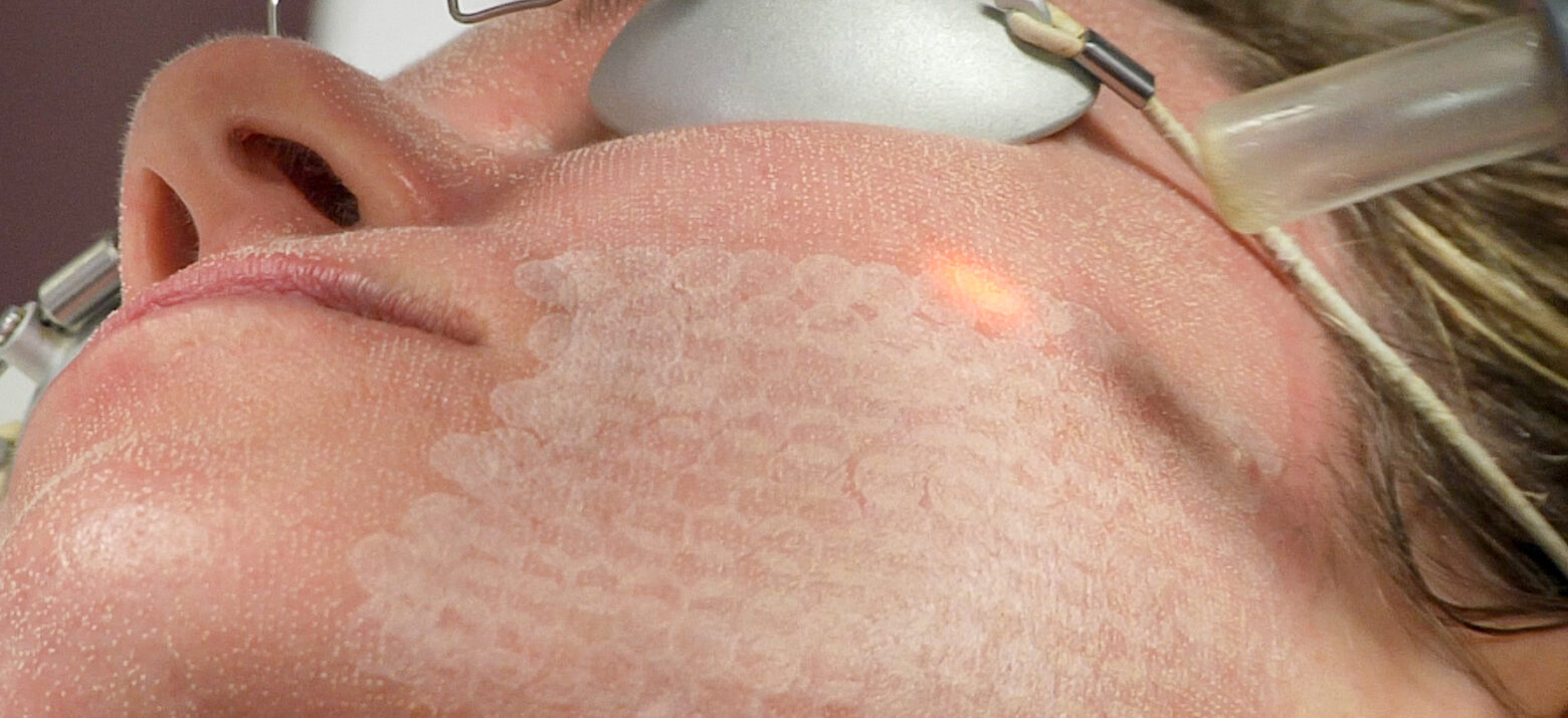 Erbium laser face ama regenerative medicine